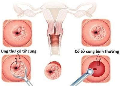 7 dấu hiệu cảnh báo ung thư buồng trứng
