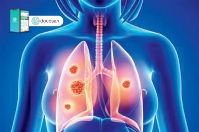 Nguyên nhân phụ nữ có nguy cơ mắc ung thư phổi cao hơn nam giới?