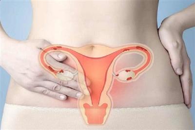 Ung thư cổ tử cung là gì và bệnh ung thư cổ tử cung có mấy giai đoạn?